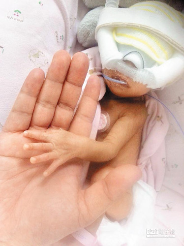 臺1350克巴掌嬰兒心導管手術成功創亞洲紀錄(圖)