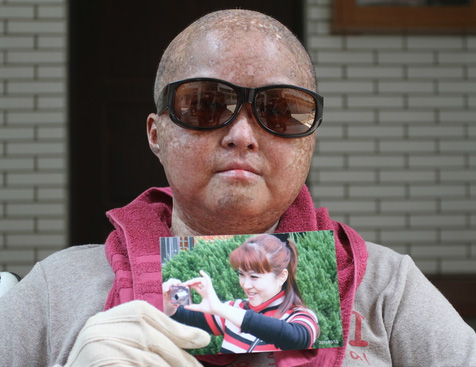 骨髓移植后驟老40歲 臺灣熟女告醫"還我青春" 骨髓移植后驟老40歲 臺灣熟女告醫"還我青春"